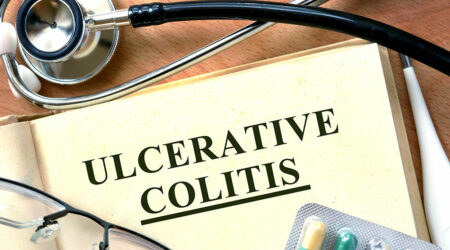 A comprehensive guide on ulcerative colitis