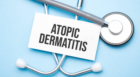 Essential things to know about atopic dermatitis