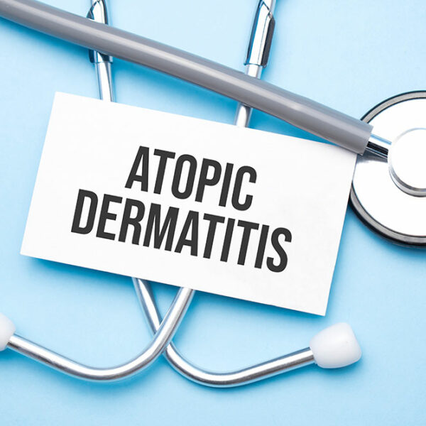 Essential things to know about atopic dermatitis