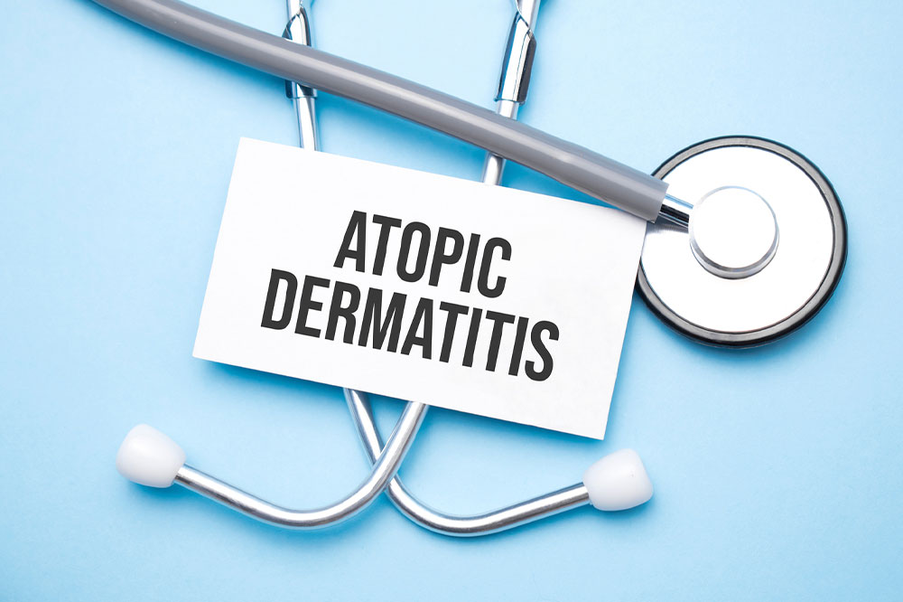 Atopic dermatitis home remedies, management options, and best foods