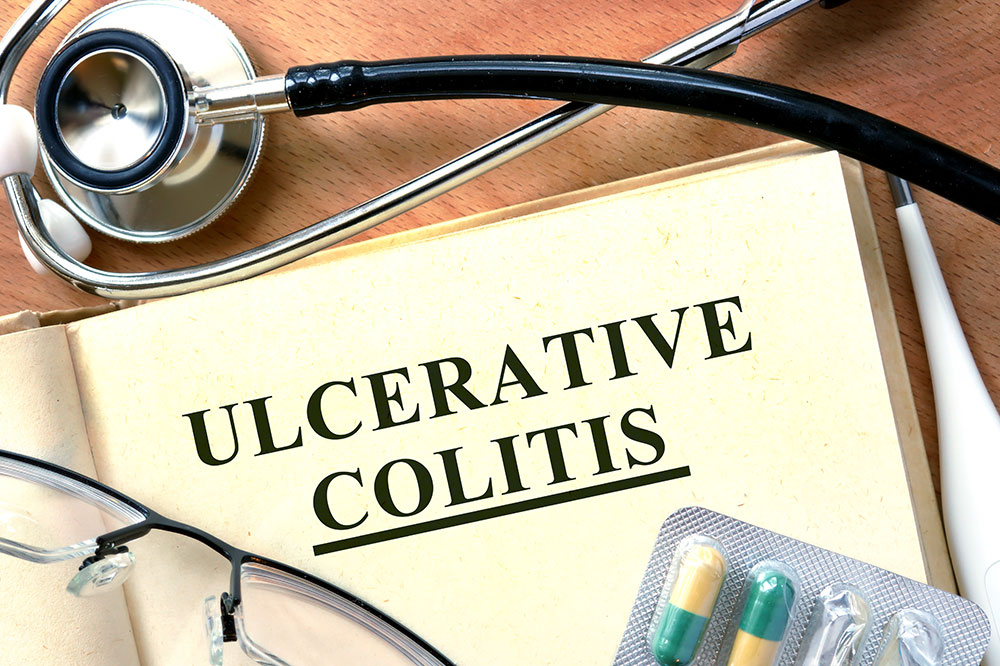 A comprehensive guide on ulcerative colitis