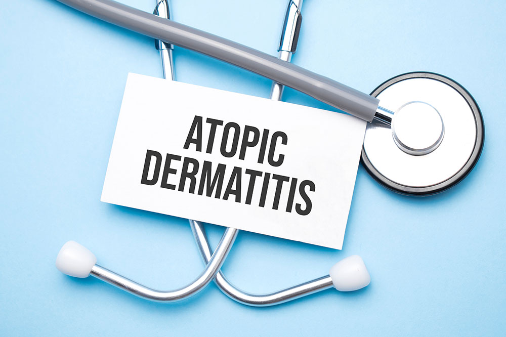 Essential things to know about atopic dermatitis